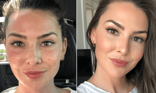 mississauga oakville plasma facial skin rejuvenation before after